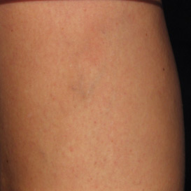 Sclerotherapy in Raleigh NC