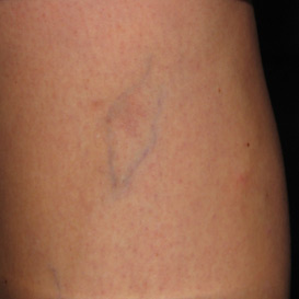 Sclerotherapy in Raleigh NC