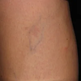 Sclerotherapy in Raleigh NC