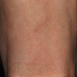 Sclerotherapy in Raleigh NC