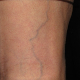 Sclerotherapy in Raleigh NC