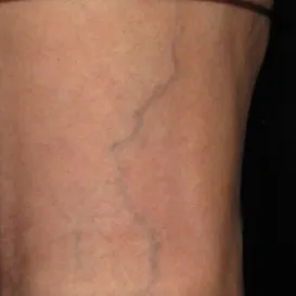 Sclerotherapy in Raleigh NC