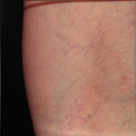 Sclerotherapy in Raleigh NC