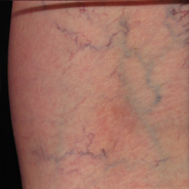 Sclerotherapy in Raleigh NC