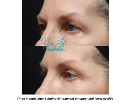 Subnovii Plasma Pen Treatment Raleigh NC