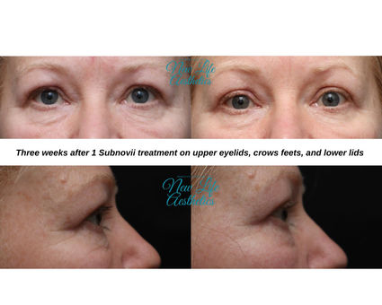 Subnovii Plasma Pen Treatment Raleigh NC