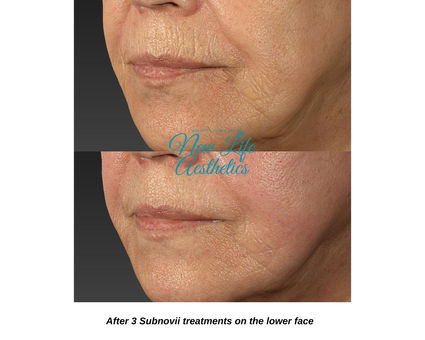 Subnovii Plasma Pen Treatment Raleigh NC