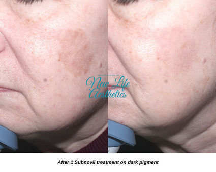 Subnovii Plasma Pen Treatment Raleigh NC