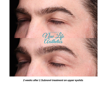 Subnovii Plasma Pen Treatment Raleigh NC