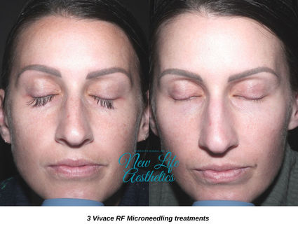 UltraVision RF Microneedling Raleigh NC