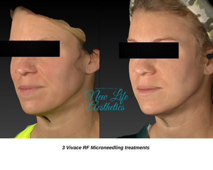 UltraVision RF Microneedling Raleigh NC