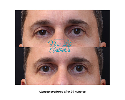 Upneeq for Acquired Ptosis Raleigh NC