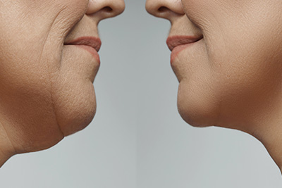 Kybella Raleigh NC